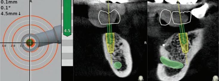 Ekran Navident pokazujący plan i położenie narzędzia w przekrojach tomografii